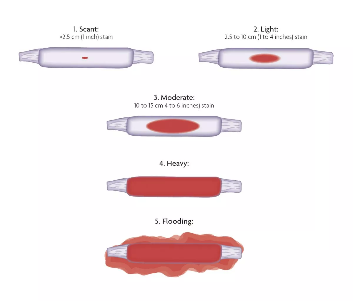 Abortion pill (Medical Abortion) bleeding