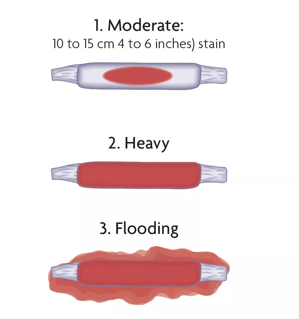 How much bleeding is too much ?